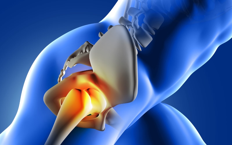 Knee & Hip Osteoarthritis